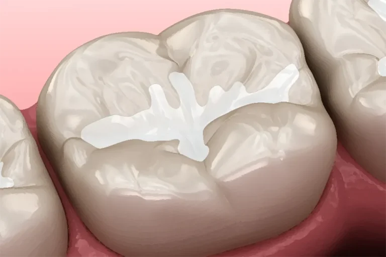 Pit & Fissure Sealants