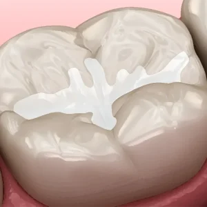 Crown & Bridge Cements