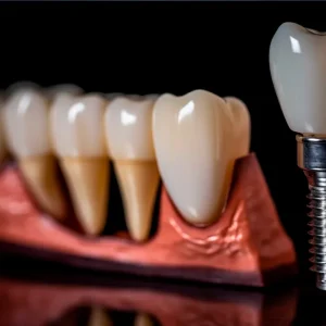 Immediate Loaded Implants