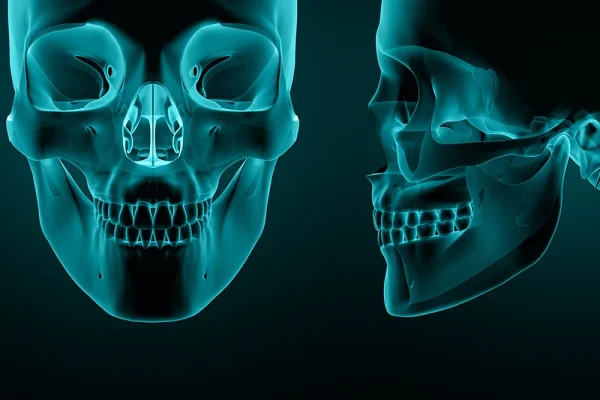 Jaw Necrosis